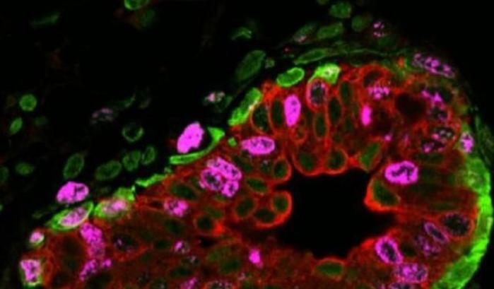 Una molecola contro il tumore del seno: controlla la crescita delle sue cellule staminali