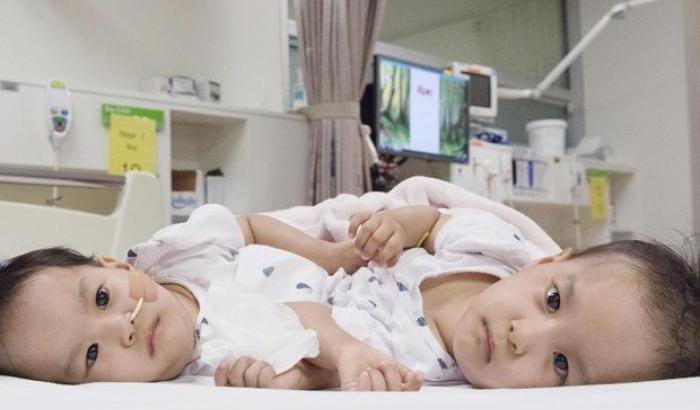 Separate due gemelle siamesi: erano unite al torso e condividevano il fegato